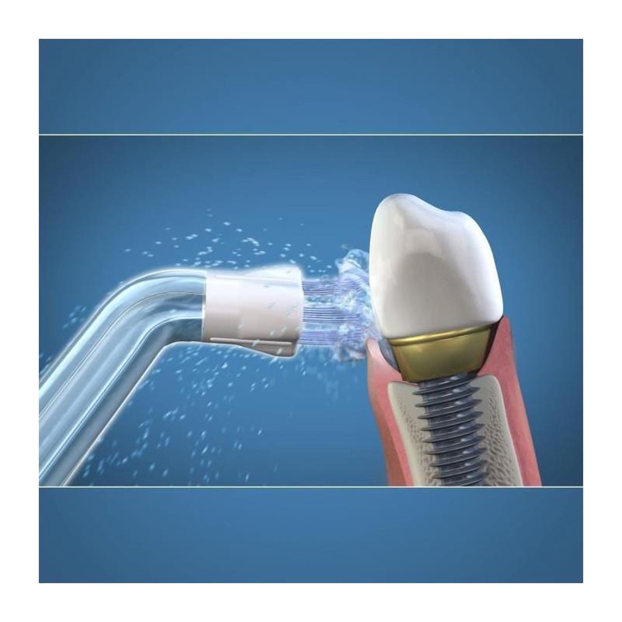 Voir la diapositive 2 : Waterpik Canule hydropulseur plaque seeker