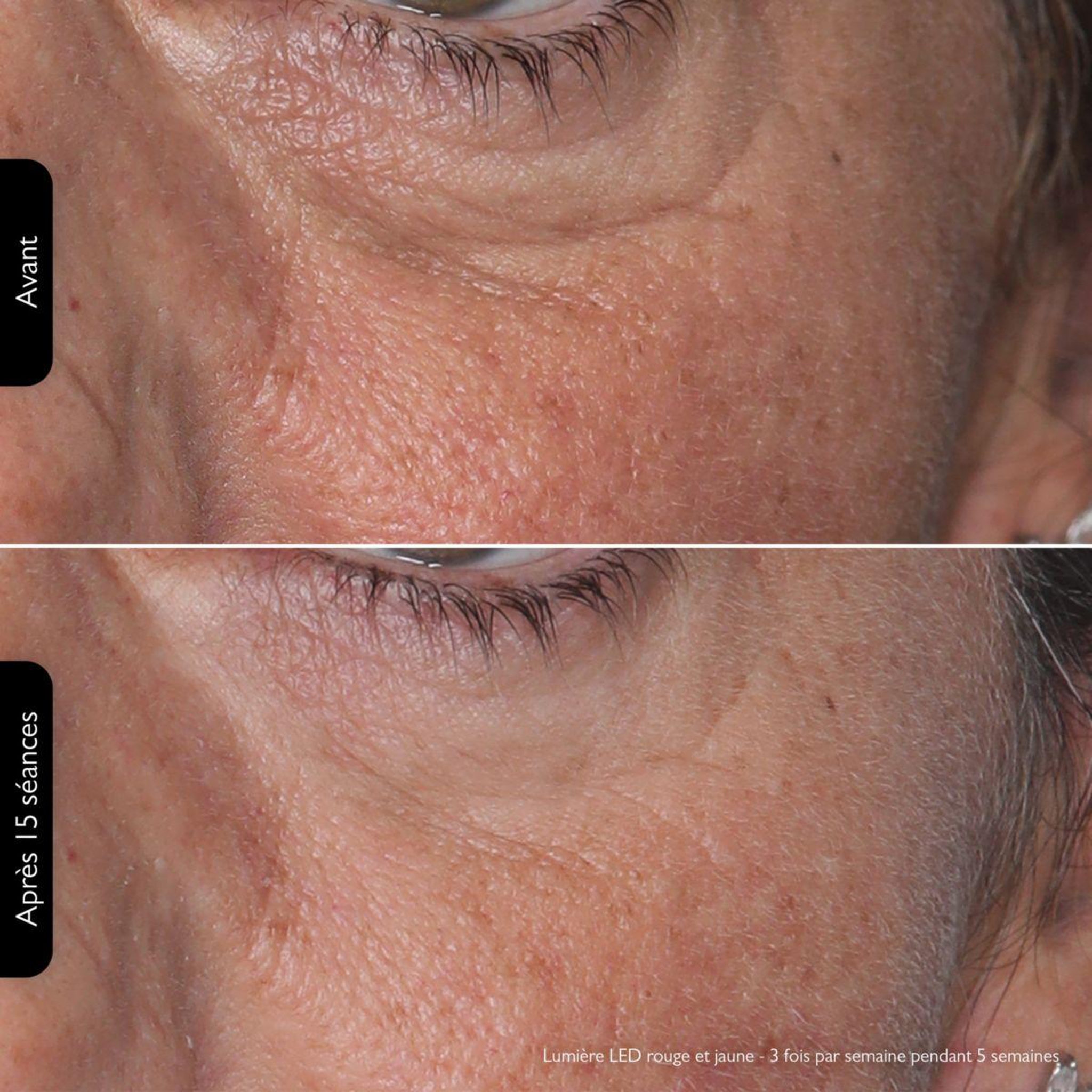 Voir la diapositive 5 : SILK'N Masque LED visage LED Face Mask 100 FLM100