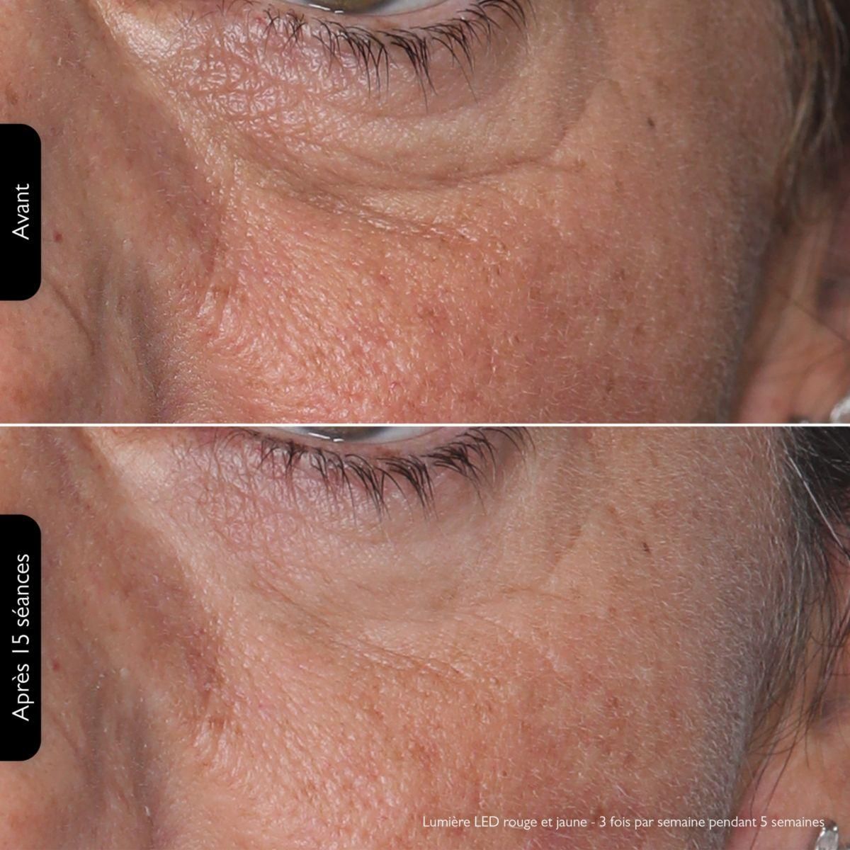 SILK'N Masque LED visage LED Face Mask 100 FLM100