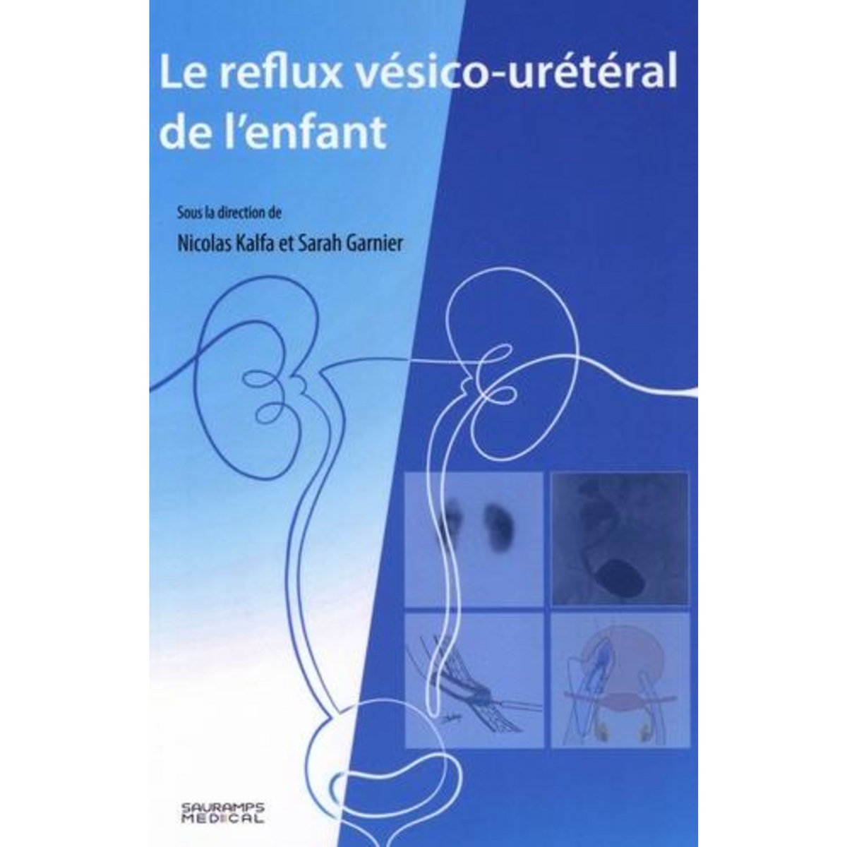 LE REFLUX VESICO-URETERAL DE L'ENFANT, Kalfa Nicolas