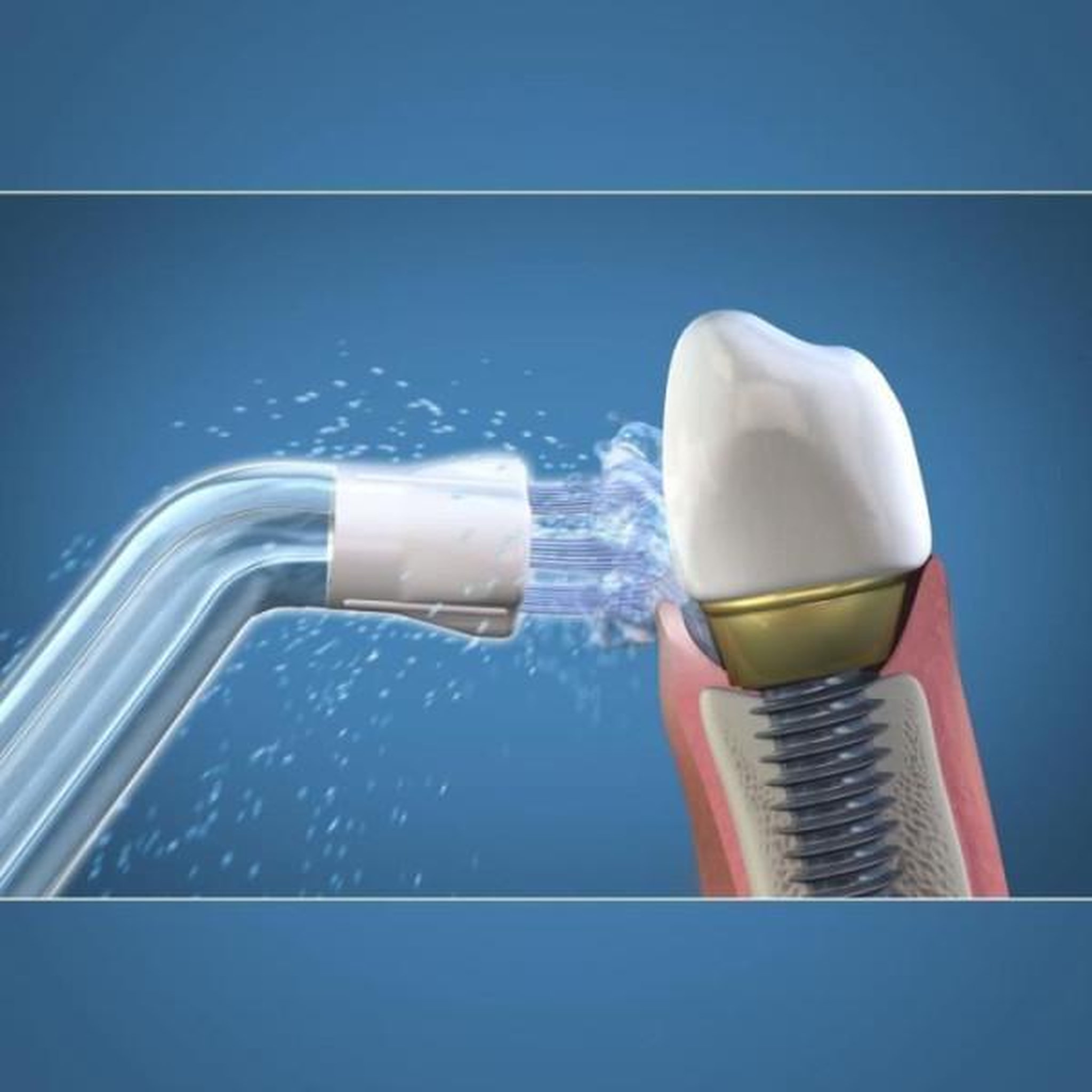 Voir la diapositive 2 : Waterpik Canule hydropulseur plaque seeker