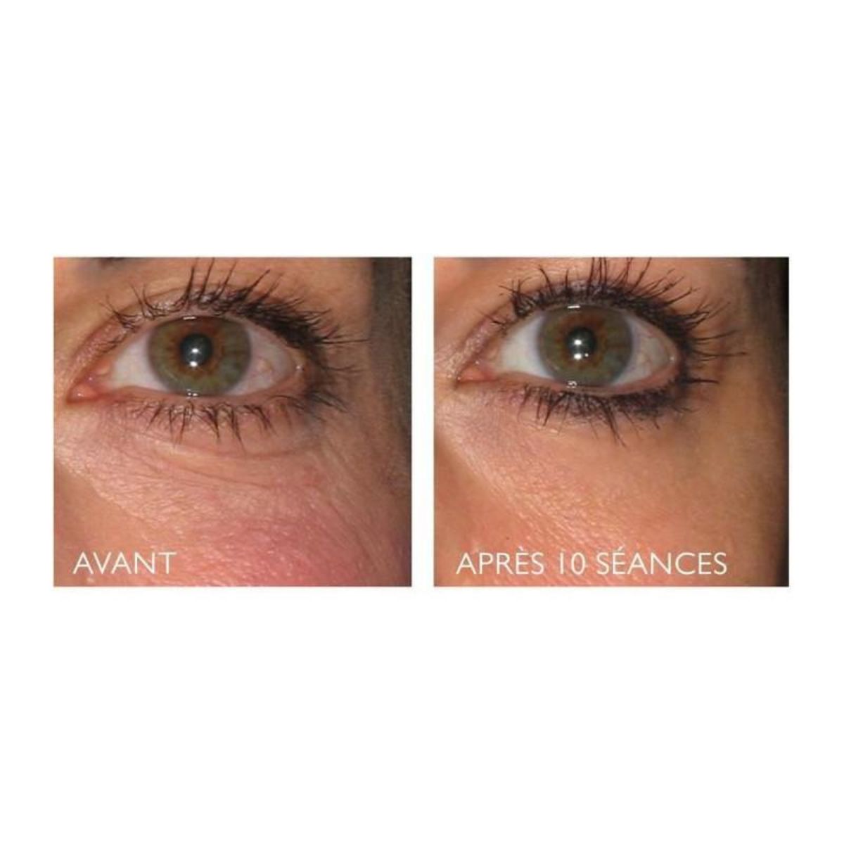 SILK'N Réductions des rides et raffermissement du visage - SILK'N Facetite Essentials - FTE1PE1R001