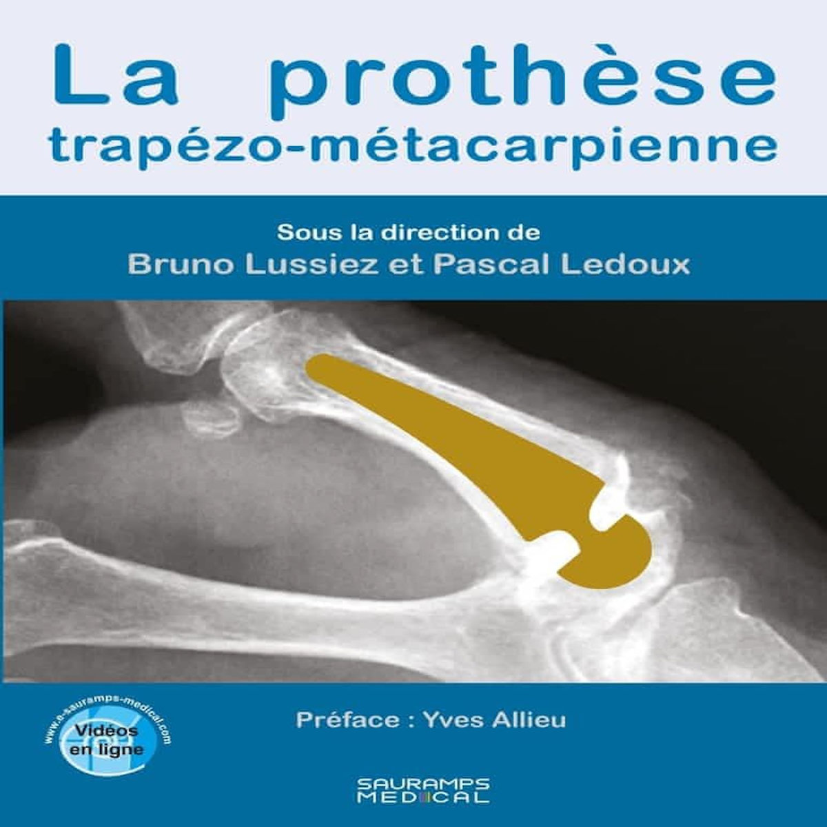 LA PROTHESE TRAPEZO-METACARPIENNE, Lussiez Bruno