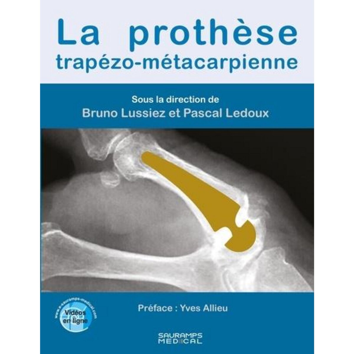 LA PROTHESE TRAPEZO-METACARPIENNE, Lussiez Bruno
