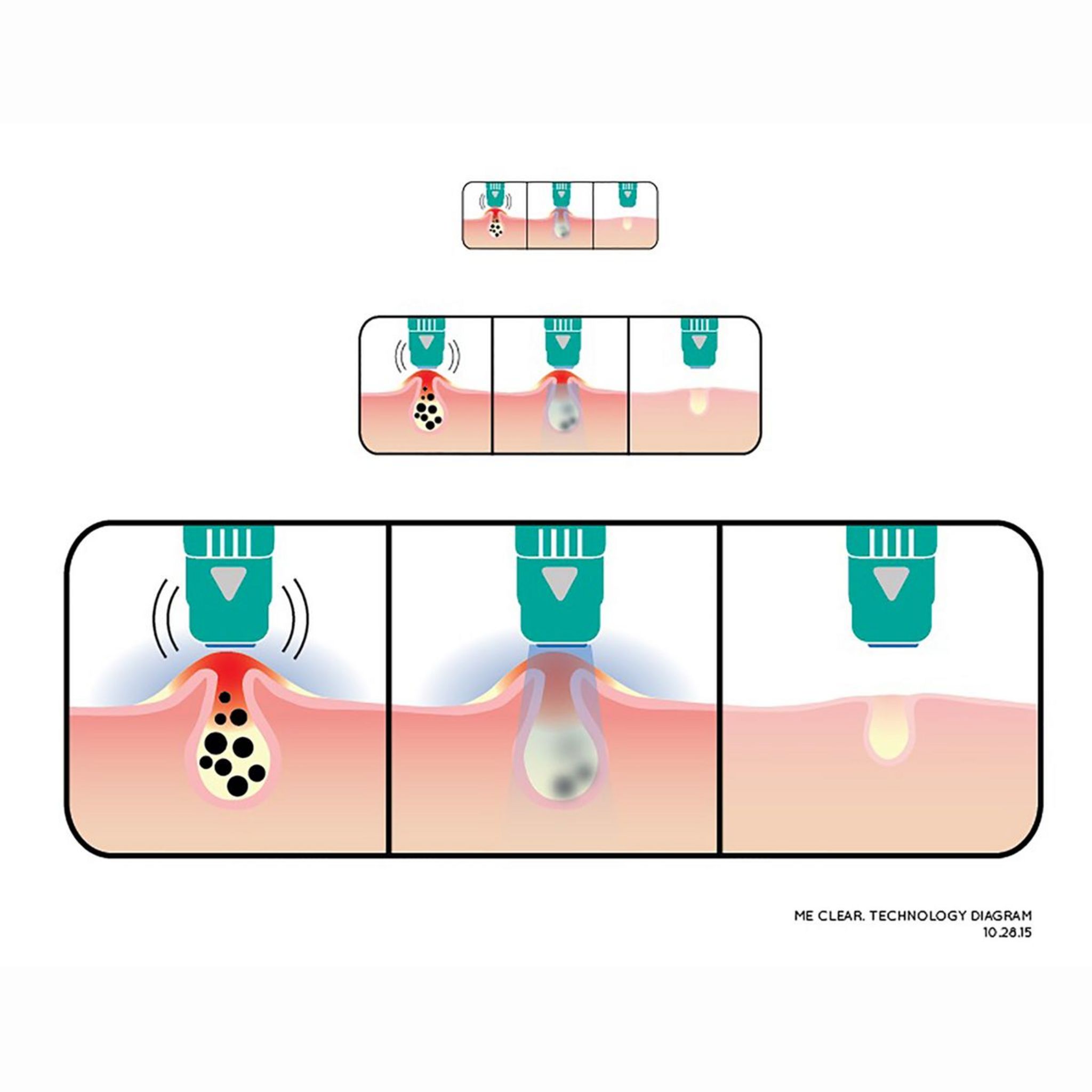 Voir la diapositive 2 : EPILADY Appareil anti-acné ME CLEAR HU-GF1401