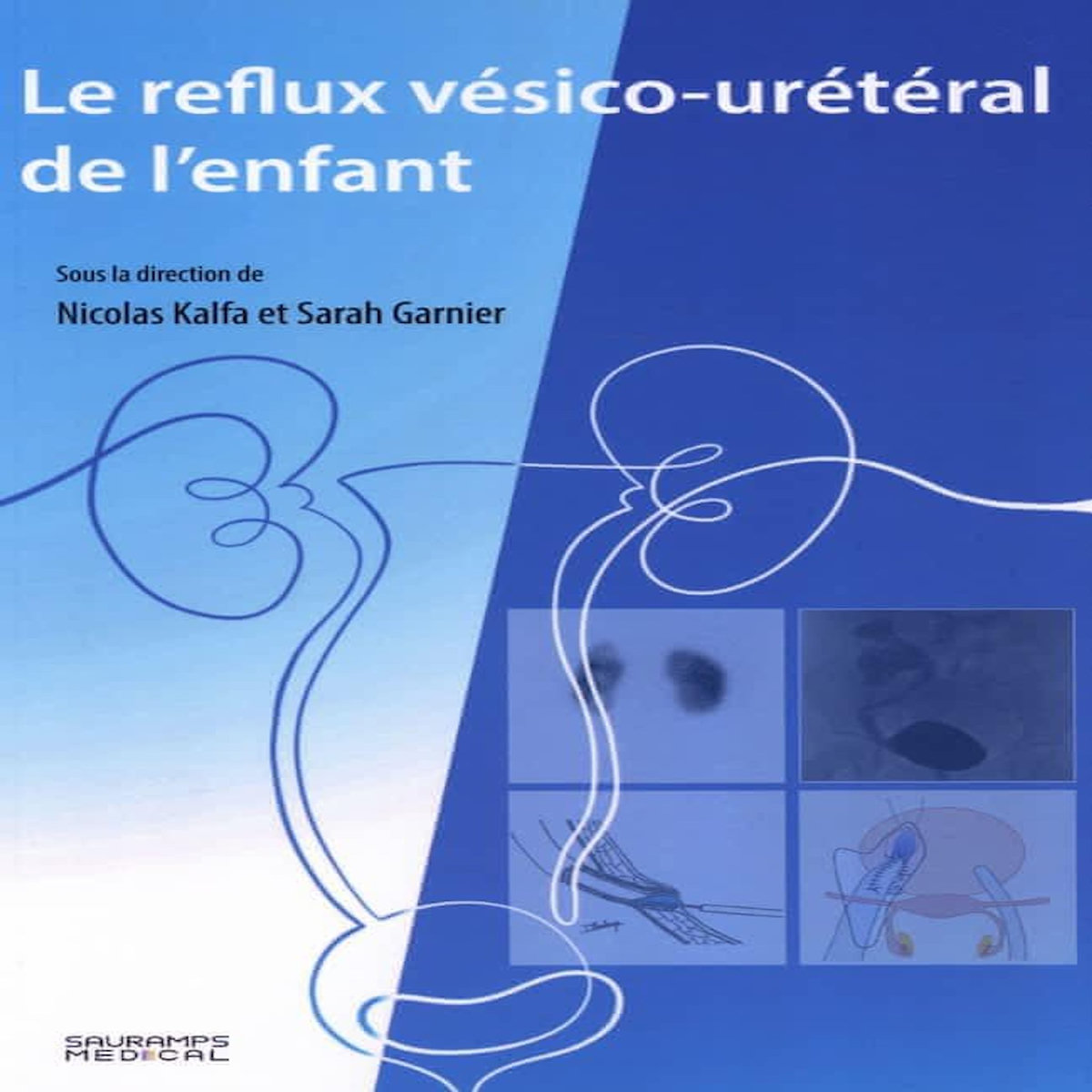 LE REFLUX VESICO-URETERAL DE L'ENFANT, Kalfa Nicolas