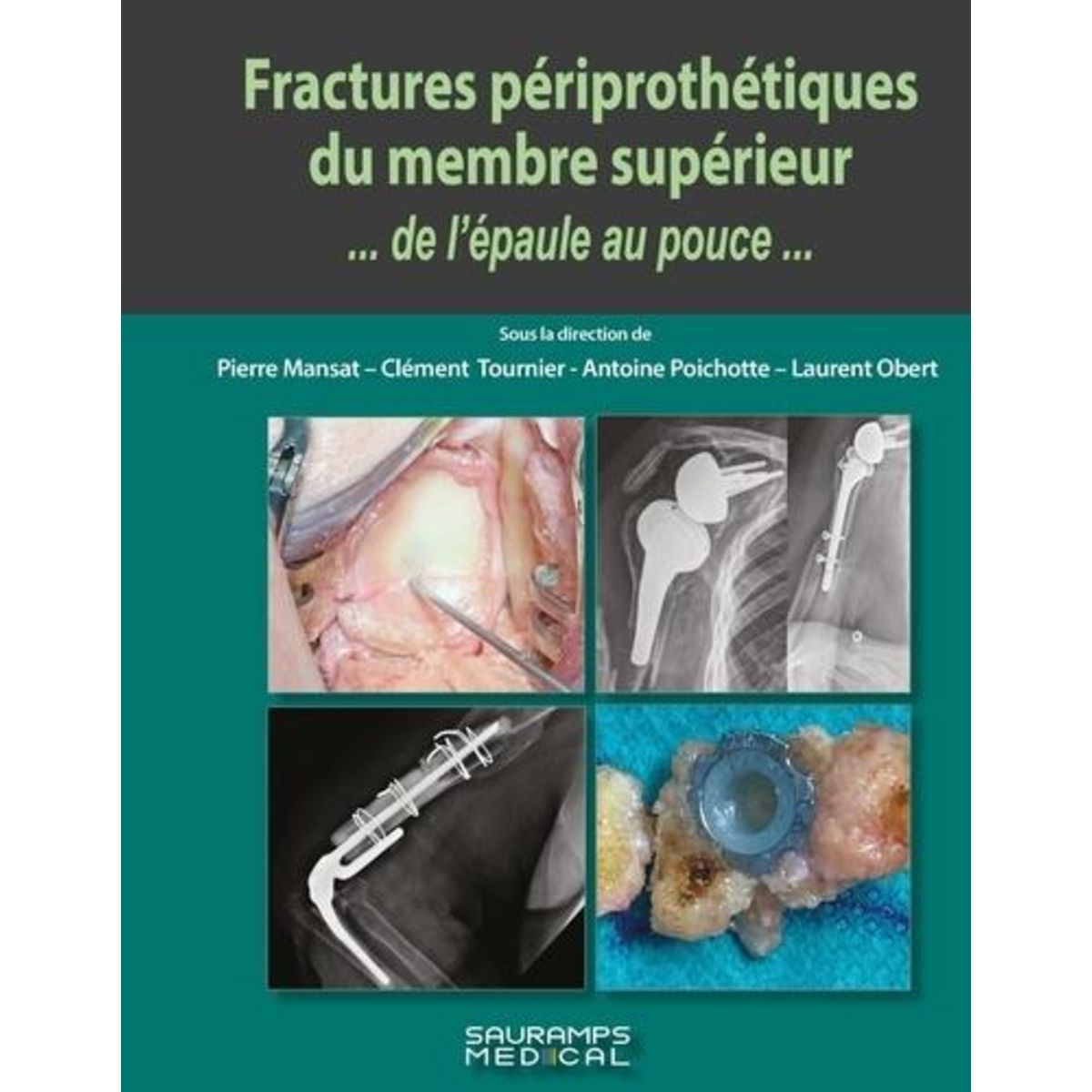 FRACTURES PERIPROTHETIQUES DU MEMBRE SUPERIEUR... DE L'EPAULE AU POUCE..., Mansat Pierre