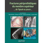 FRACTURES PERIPROTHETIQUES DU MEMBRE SUPERIEUR... DE L'EPAULE AU POUCE..., Mansat Pierre