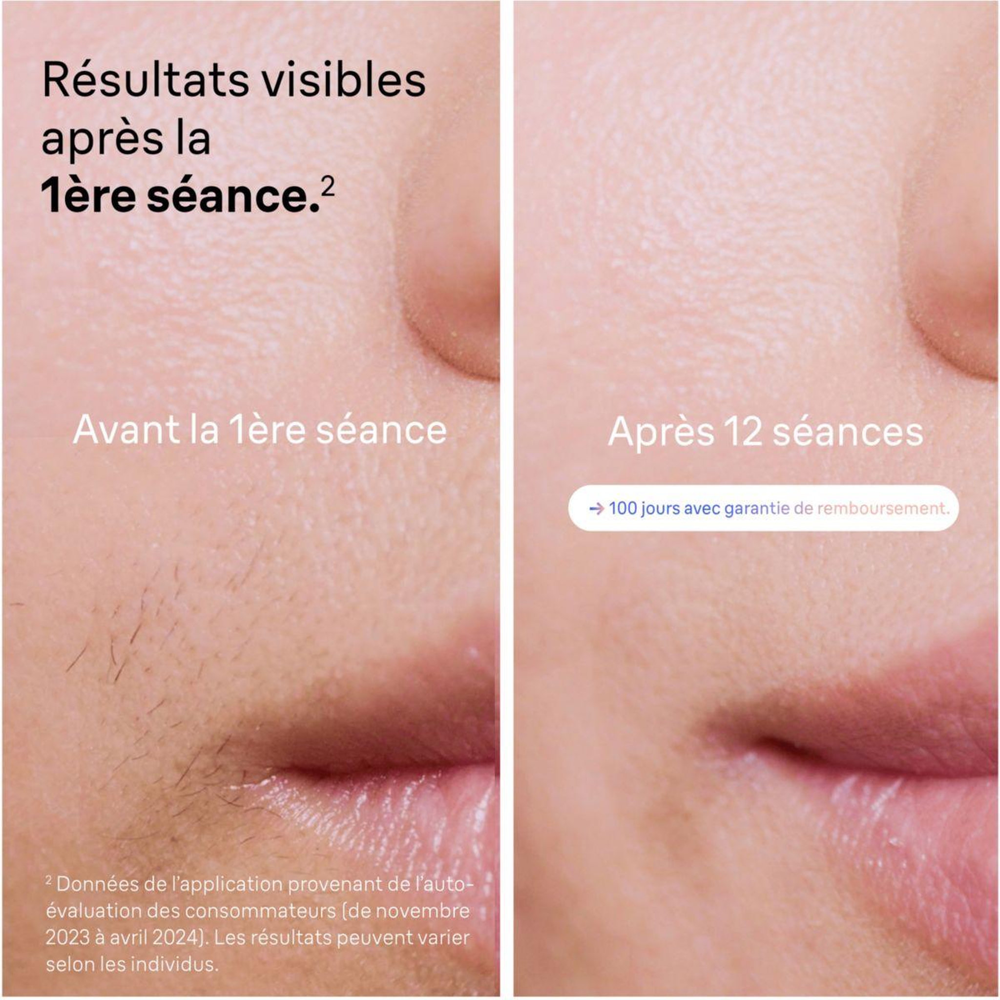Voir la diapositive 4 : BRAUN Epilateur lumière pulsée IPL PL7147 Skin i-expert