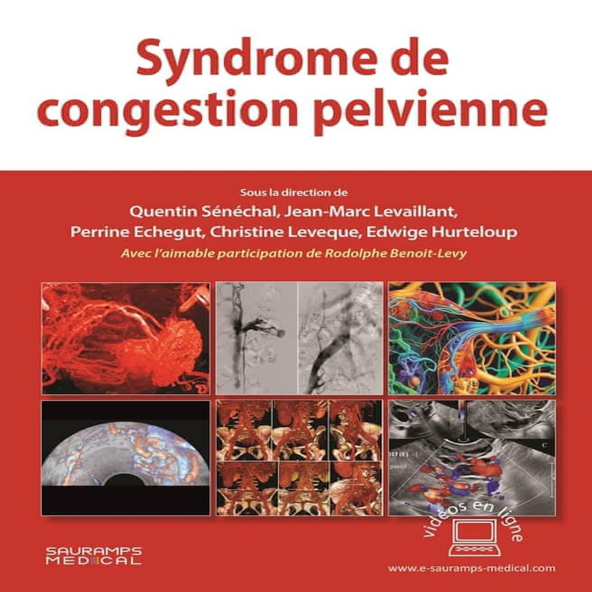 SYNDROME DE CONGESTION PELVIENNE, Sénéchal Quentin