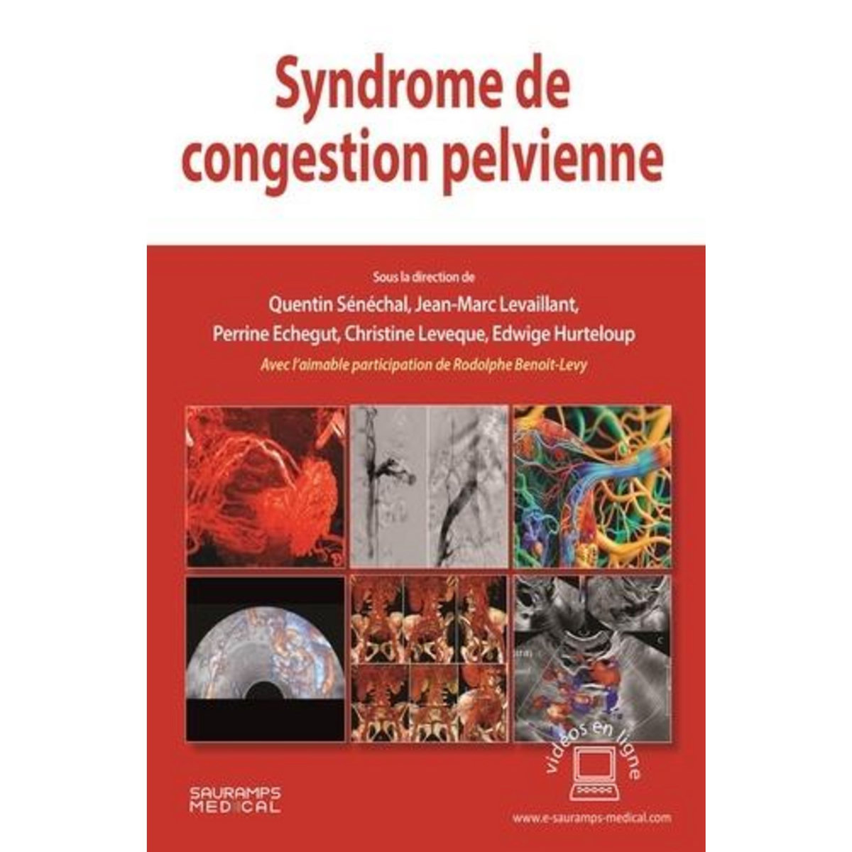 SYNDROME DE CONGESTION PELVIENNE, Sénéchal Quentin